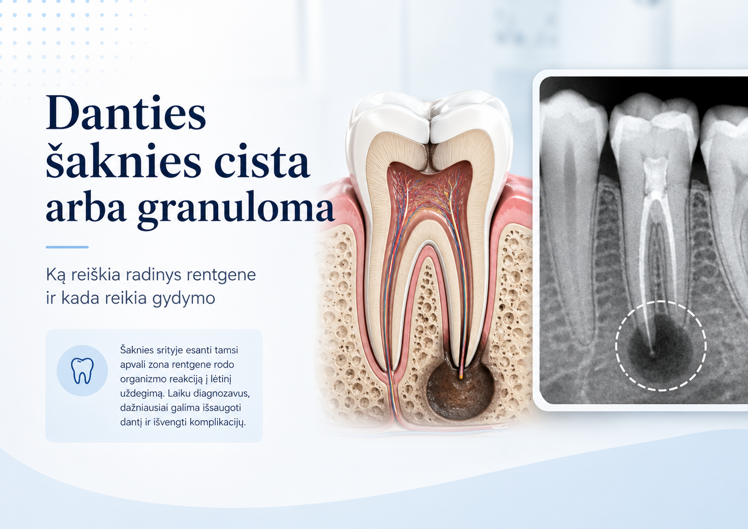 Danties šaknies cista arba granuloma: ką reiškia radinys rentgene ir kada reikia gydymo