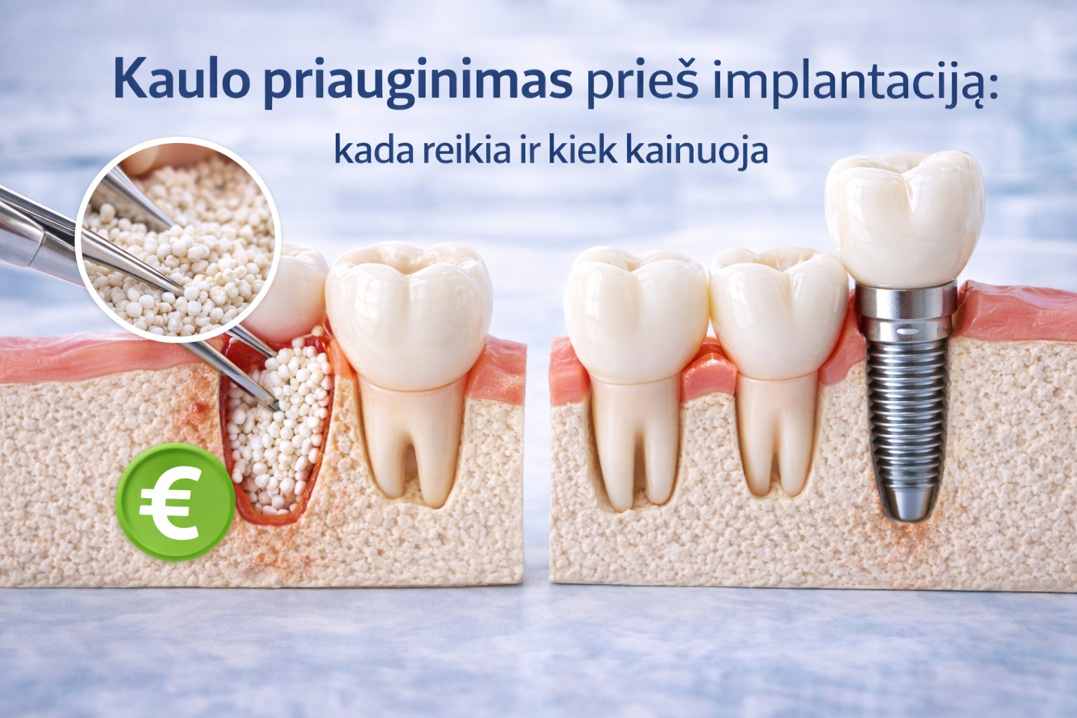 Kaulo priauginimas prieš implantaciją: kada reikia ir kiek kainuoja