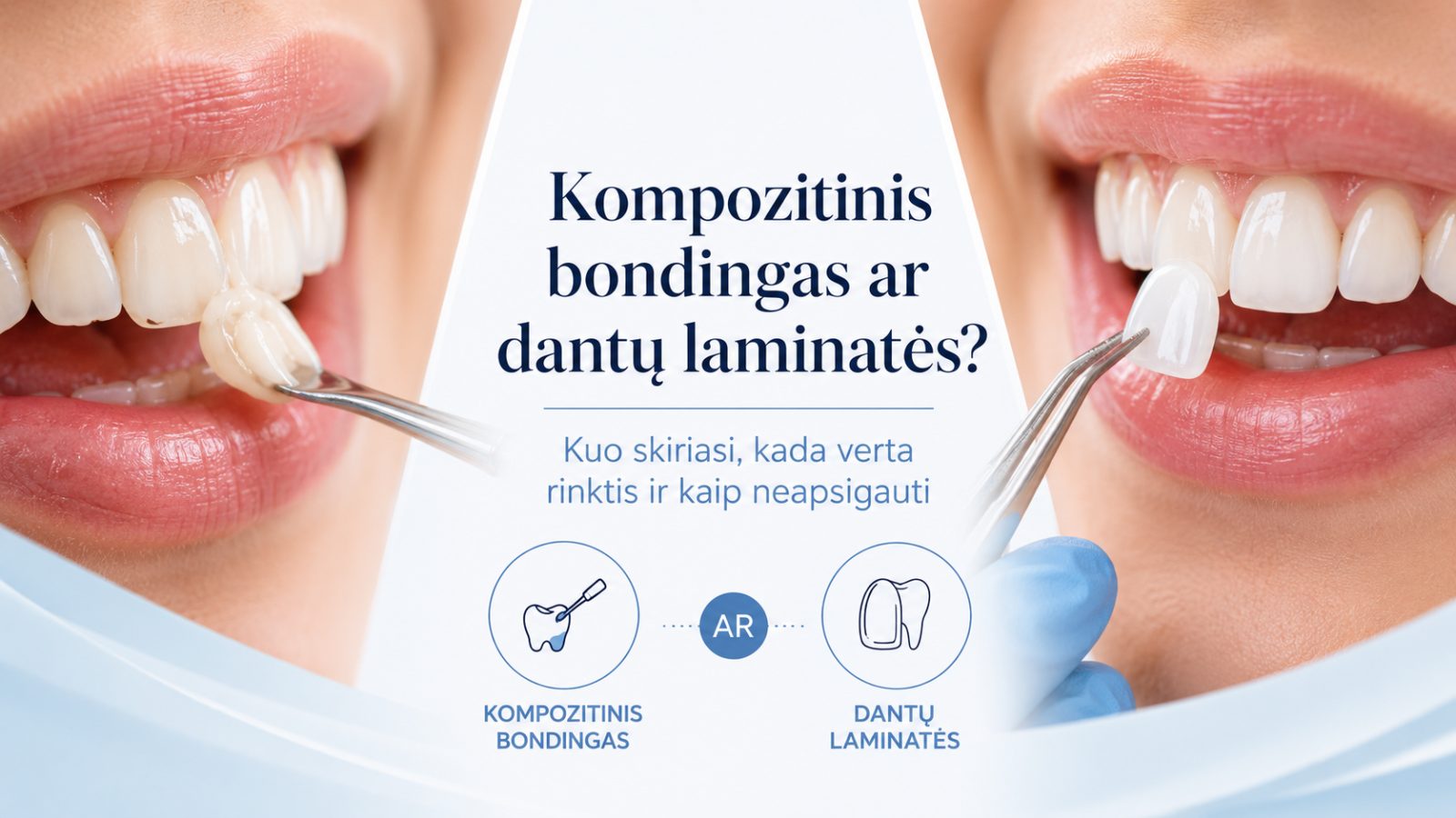 Kompozitinis bondingas ar dantų laminatės: kuo skiriasi, kada verta rinktis ir kaip neapsigauti